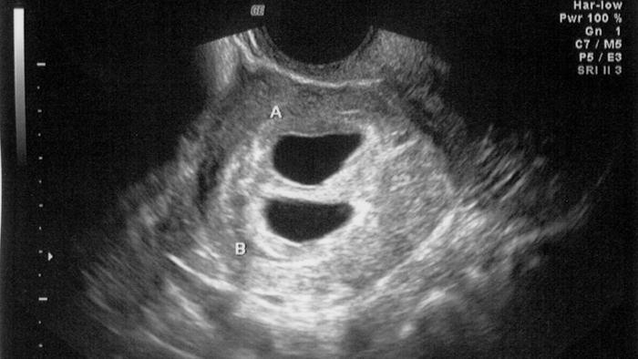 Ultrasound 4 weeks 4 days